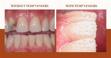 What Do Temporary Veneers Look Like? - WildeWood Aesthetic Dentistry