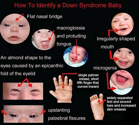 Indo American Hospital : Down syndrome