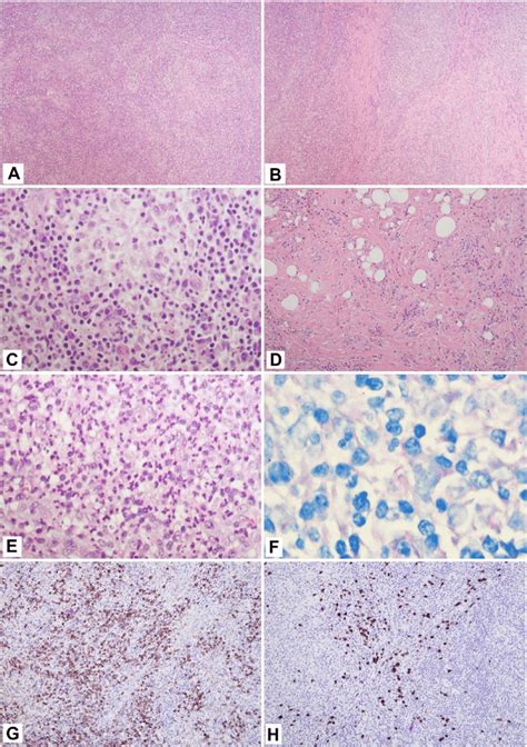 Excisional biopsy of right axillary lymph node; A, Effacement of normal... | Download Scientific ...