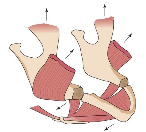 Bucket Handle Fracture