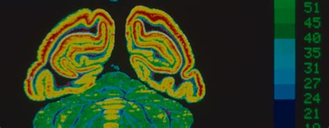 Truly Translational: Louis Sokoloff and PET Brain Imaging – Circulating ...