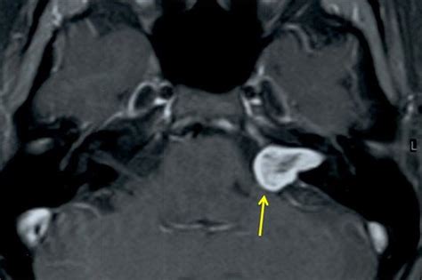 Image Bank: MRI Image of Acoustic Neuroma | Memorial Sloan Kettering ...