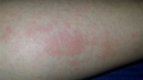 What Does Lupus Rash Look Like On Legs - Infoupdate.org