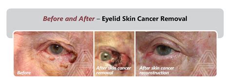 Eyelid & Facial Skin Cancer | Triad Eye Institute