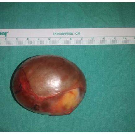 View of an ovarian dermoid cyst during ovary sparing surgery ...