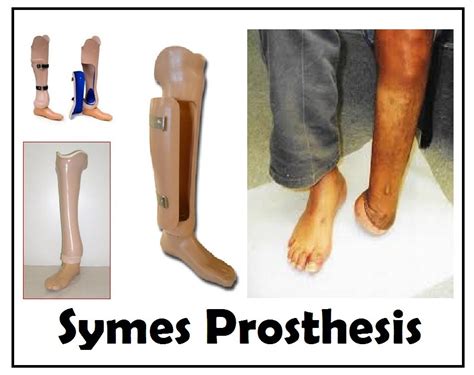 Mycare Prosthetic Foot Chopart Symes Prosthesis (Ankle Disarticulation) For Walking, Thickness ...