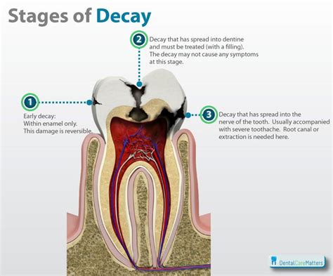 Stages of tooth decay | Dental decay, Dentistry, Oral health