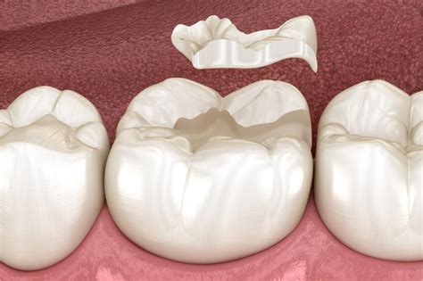 Do Cavity Fillings Hurt? Dental Filling Procedure Explained
