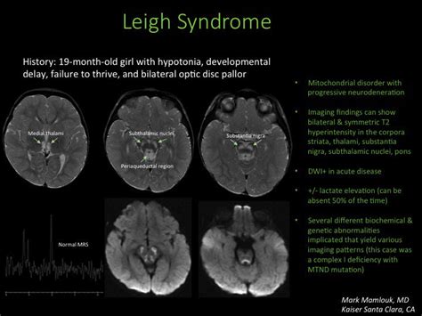 Leigh Syndrome Mri