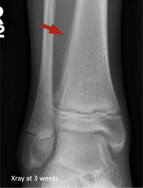 Don't Miss the Occult Fracture | Resus