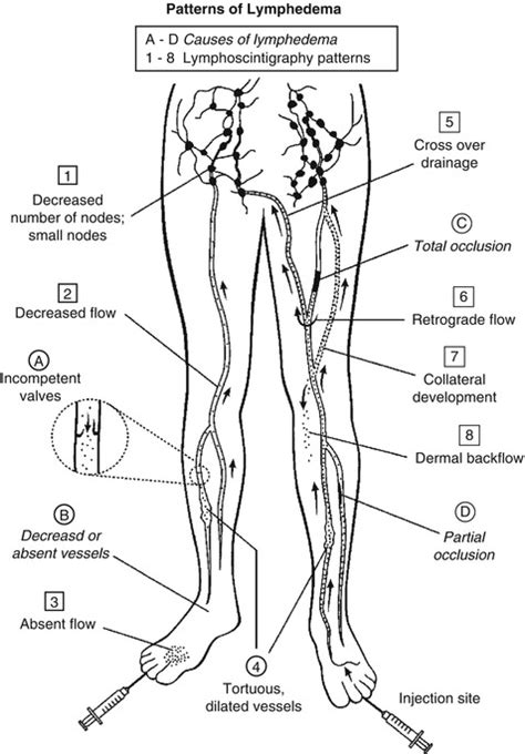 Lymphoscintigraphy | Radiology Key