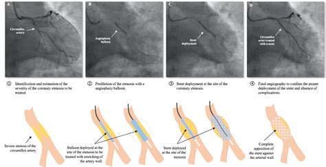 Coronary angioplasty and stent implantation - Centre de Cardiologie Interventionnelle Belledonne