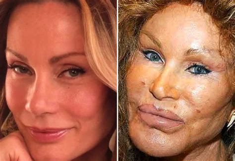 Los antes y después de las celebridades tras el botox | Emol Fotos