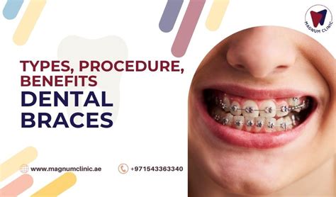 Types of dental braces | Treating Misaligned & Crooked Teeth with Braces