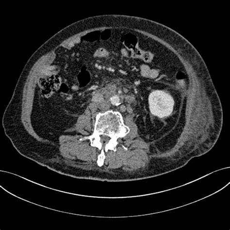 Ct Scan Showing The Para Aortic Lymph Node Enlargement Arrow | Images ...