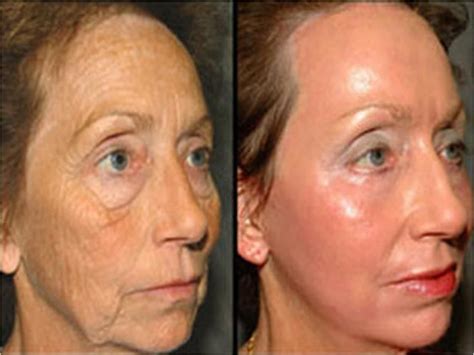 Before and After pictures using serum and moisturizer by Luminesce www.agelessgrace ...