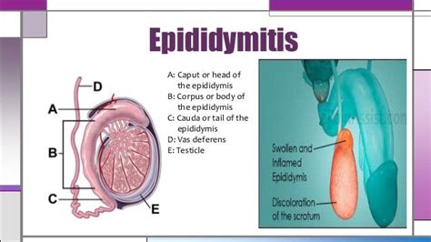 Orchitis & epididymitis