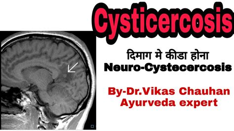 Cysticercosis treatment in Ayurveda - YouTube