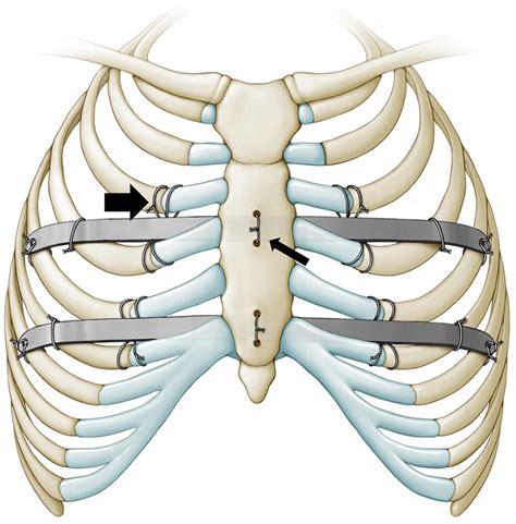 Risk Factors and Techniques for Safe Pectus Bar Removal in Adults After Modified Nuss Repair ...