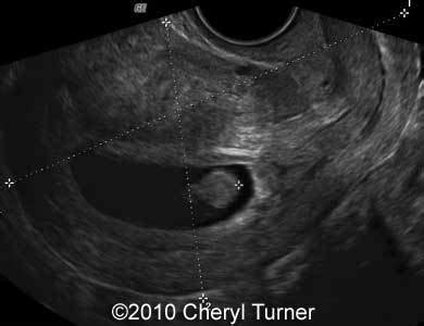 Polyp Cervix Ultrasound