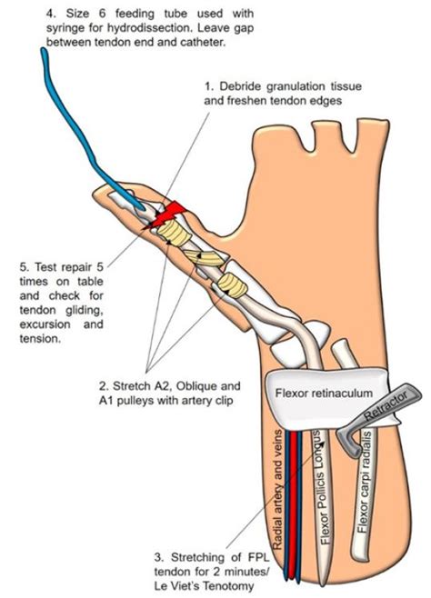 Tips and tricks for getting more out of your delayed primary repair of ruptured flexor pollicis ...