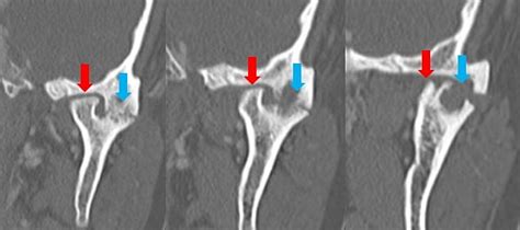 Bifid Mandibular Condyle With Associated Temporomandibular Joint ...