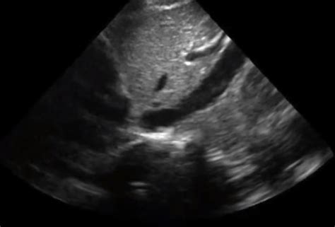 Can IVC collapsibility predict fluid responsiveness in non-ventilated ...