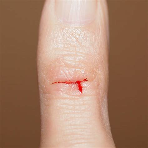 Best Cut Finger Stock Photos, Pictures & Royalty-Free Images - iStock