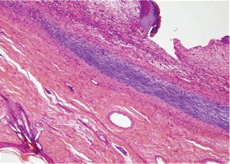 Histology of auricular cartilage defect. (a) Normal cartilaginous... | Download Scientific Diagram