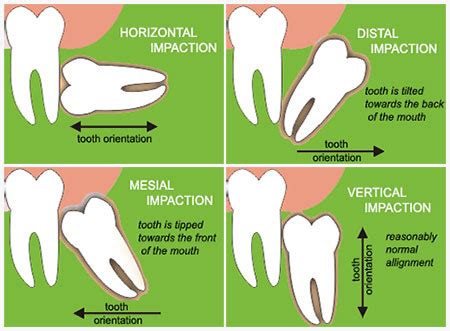 types wisdom teeth extractions