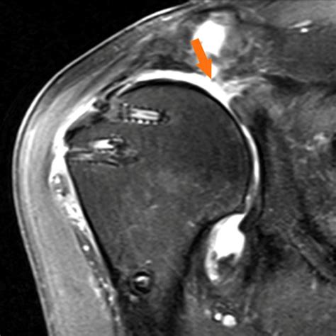 Arthroscopic view (left shoulder, view from the posterolateral portal,... | Download Scientific ...