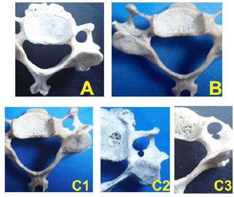 A: Circular type Foramen Transversarium. 1B: Elliptical type Foramen... | Download Scientific ...