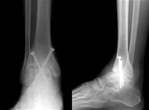 Complication with arthroscopic ankle arthrodesis was of a technical ...