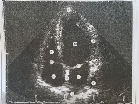 Apical 4 chamber view Diagram | Quizlet