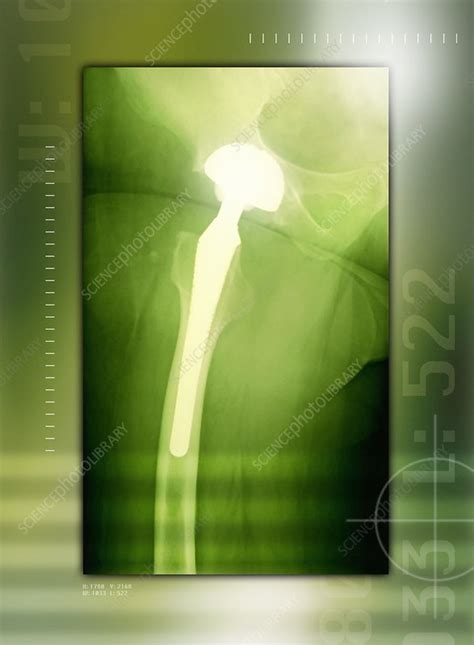 Hip replacement, X-ray - Stock Image - M600/0283 - Science Photo Library