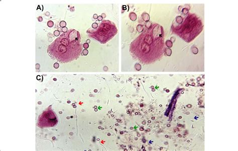 Representative image of the urinary sediment of a patient with E. coli ...