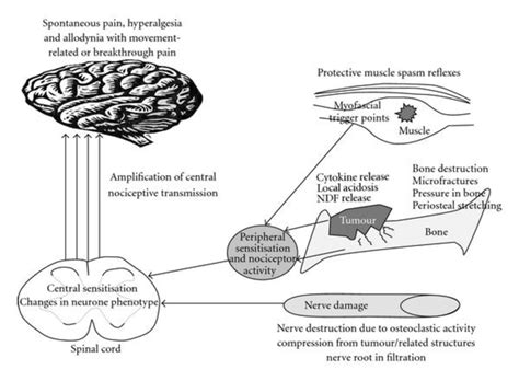 Mechanisms of cancer-induced bone pain. | Download Scientific Diagram