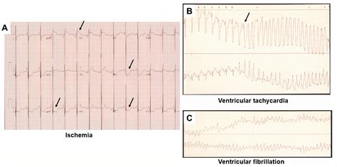 Restrictive cardiomyopathy: from genetics and clinical overview to ...