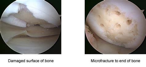 Microfracture - David Stock, Consultant Orthopaedic Surgeon