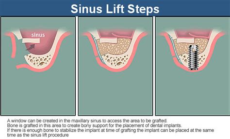 Sinus Lift Glendale - Smile Makeover of LA