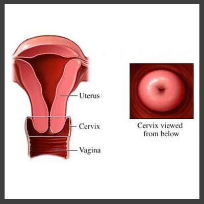 homeopathic treatment for Cervical dysplasia in homeopathy, Cervical dysplasia Treatment in ...