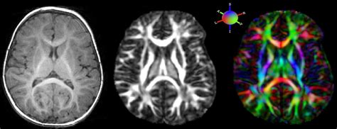 Diffusion Tensor Imaging 101 | Diffusion Imaging; Introduction, tutorials and background on ...