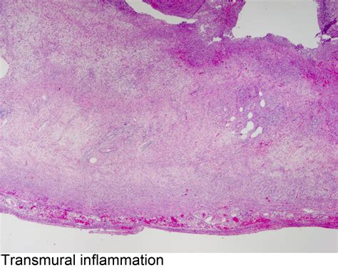 Pathology Outlines - Acute appendicitis