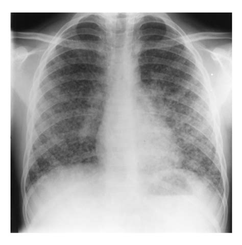 Histoplasmosis - The Clinical Advisor