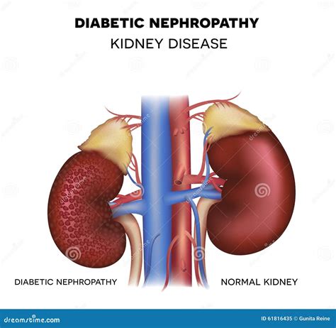 Diabetic Nephropathy, Kidney Disease Cartoon Vector | CartoonDealer.com #61816435