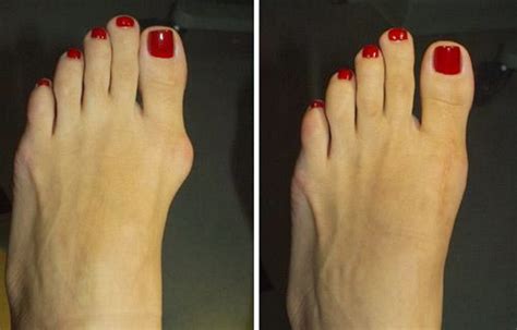 Foot Deformities in CT: 6 Myths About Bunion Surgery