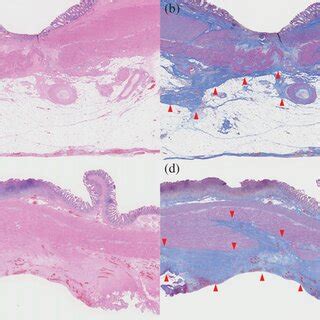 Histological findings. (a, b) Histology of the sigmoid colon. The ulcer ...