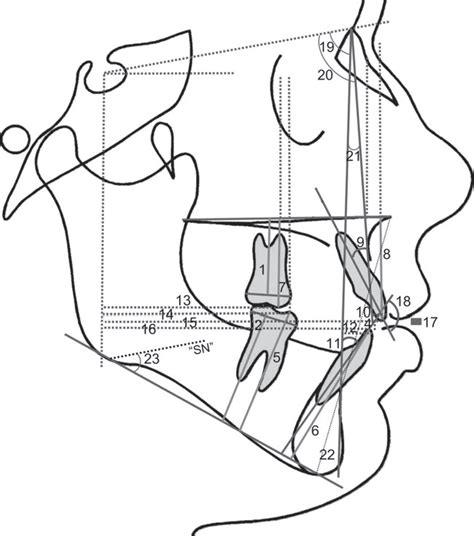 Anterior open bite | Semantic Scholar