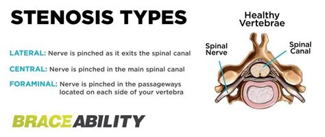 The Difference Between Foraminal, Central, & Lateral Recess Stenosis in Your Spinal Cord ...