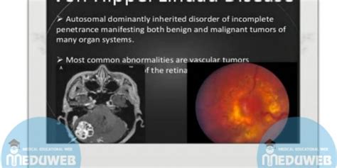 Von Hippel Lindau Syndrome - Meduweb